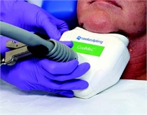 CoolMini Device Being Used to Treat Submental Fat on the Chin