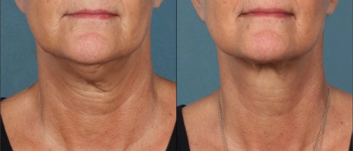 Kybella Before and After