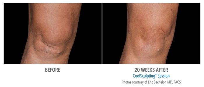 CoolSculpting Before and After