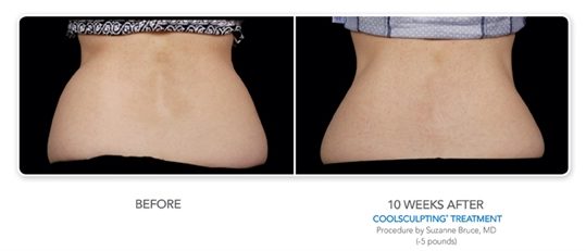 CoolSculpting Before and After