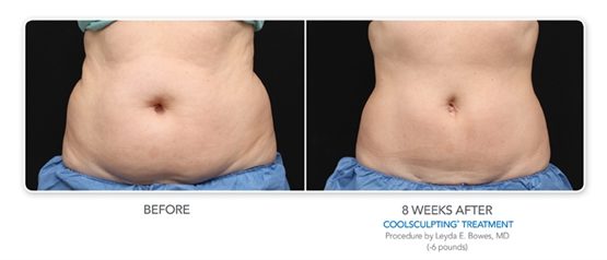 CoolSculpting Before and After