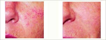 Rosacea