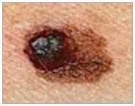 Skin Cancer Detection