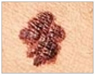 Skin Cancer Detection