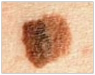 Skin Cancer Detection