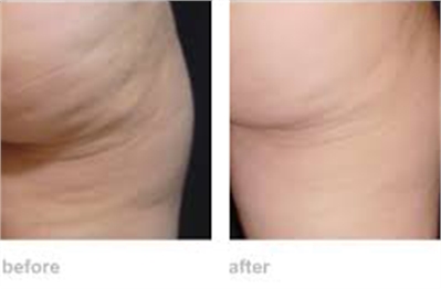 ZWave Pro for Cellulite