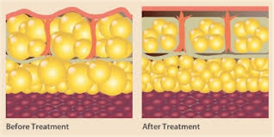 ZWave Pro Treatment