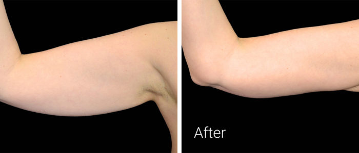 Before After Arm