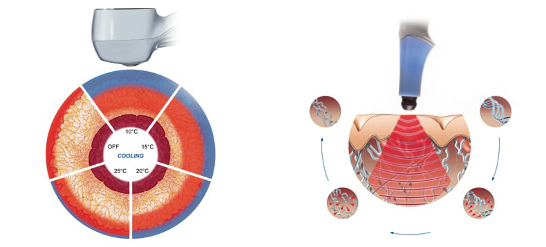 Exilis Diagram